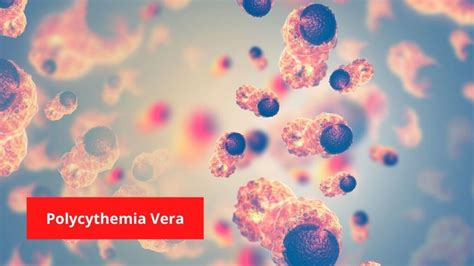 Polycythemia Vera Symptoms And Treatment Ncert Infrexa