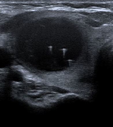 Colloid Nodule Of The Thyroid Radiology Case Radiopaedia Org