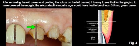 A Comprehensive Guide To Biologic Width - Spear Education