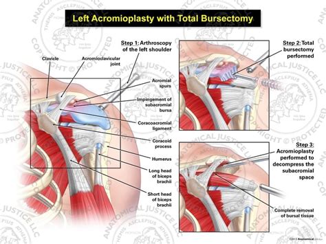 Left Acromioplasty With Total Bursectomy