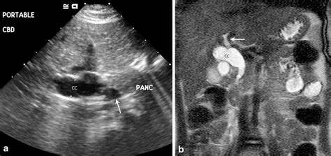 Choledochal Cyst In A 4 Year Old Girl Who Presented With Several Months Download Scientific