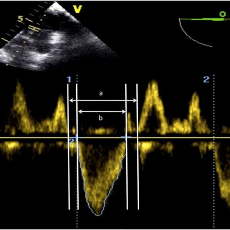 Schematic Representation Of The Measurement Of The Left Ventricle Download Scientific Diagram