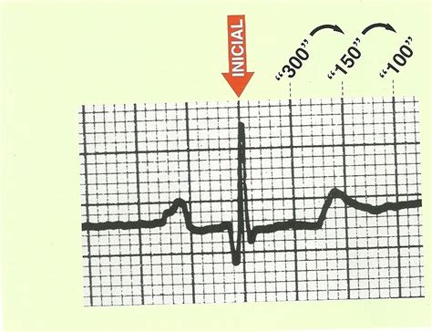 Aprende A Calcular La Frecuencia Cardíaca De 3 Formas Diferentes En El Ecg Video Frecuencia