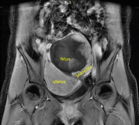 Abdominal Pregnancy Mri Coronal Position The Fetus Is Located At The