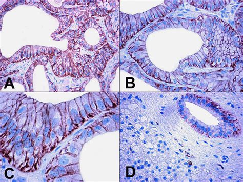 A The Neoplastic Biliary Epithelial Cells Of The Well Differentiated