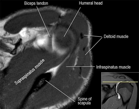 Shoulder Impingement MRI