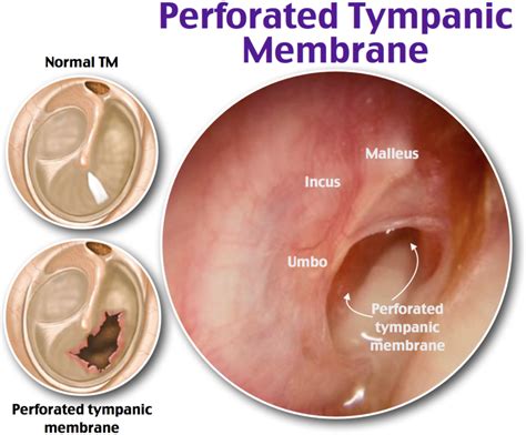 Tympanic Membrane Otitis Media