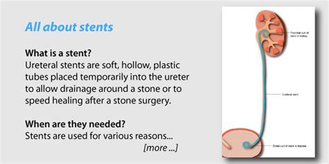 Kidney: Stent For Kidney Stone