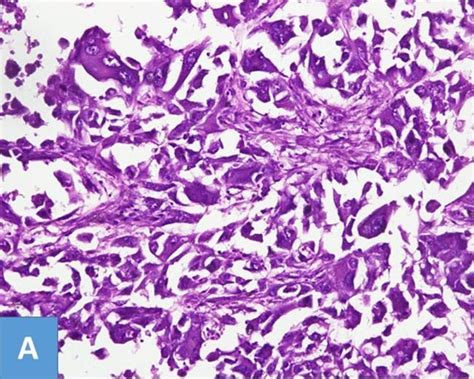 Invasive Ductal Carcinoma Histology