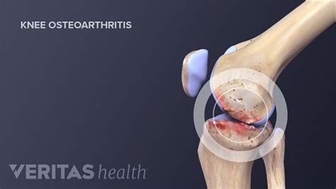 Knee Osteotomy Surgery