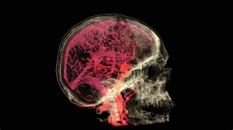 Blood Vessels Of The Brain Mri Photograph By Anatomical Travelogue