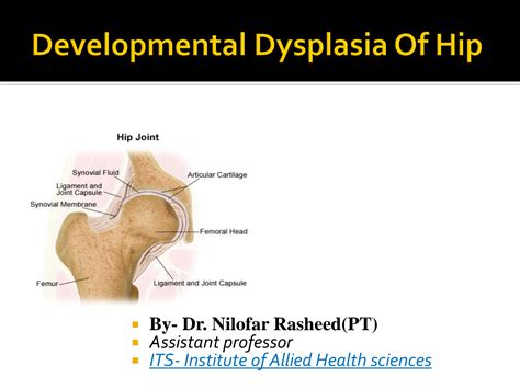 SOLUTION: Developmental dysplasia of hip - Studypool