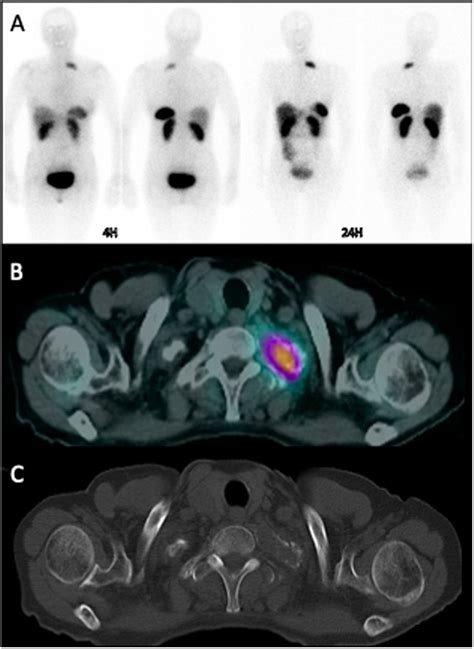 In Pentetreotide Whole Body Scan A And Spect Ct B And Ct C