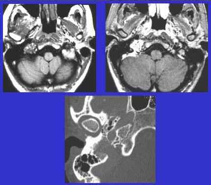 Glomus Jugulare Tumor