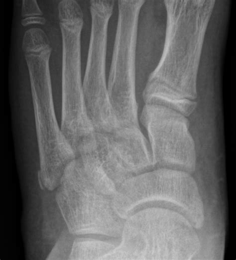 Apophysis Of The Proximal 5th Metatarsal Image