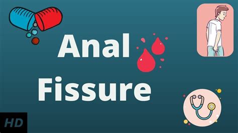 ANAL FISSURE Causes Signs And Symptoms Diagnosis And Treatment YouTube