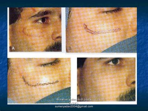 scar revision , z plasty