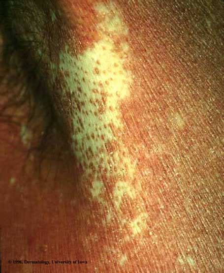 Pityriasis Rubra Pilaris Dermnet