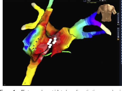 Figure From Para Hisian Atrial Tachycardia Ablation In A Patient With