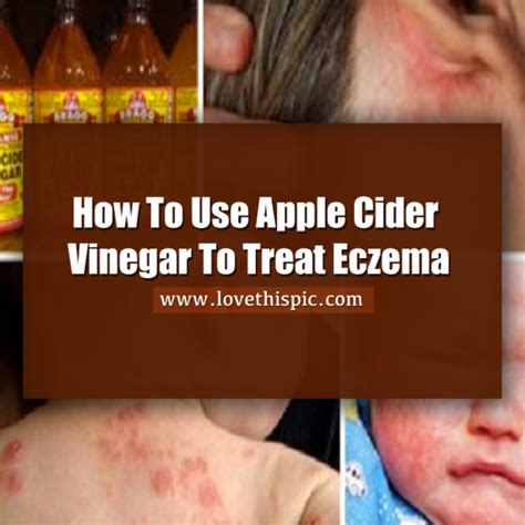 How To Use Apple Cider Vinegar To Treat Eczema