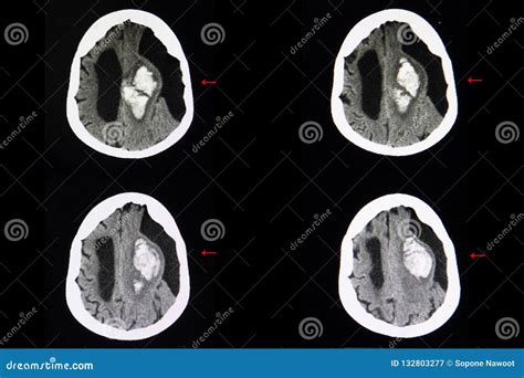 Brain Ct Scan Intracerebal Hemorrhage And Subarachnoid Cyst Stock