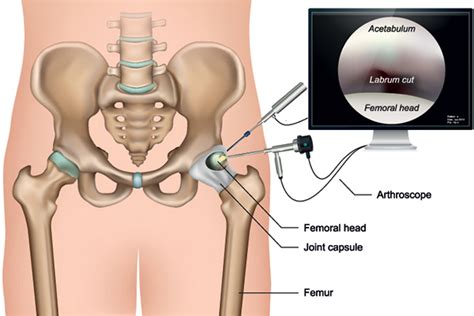 Hip Arthroscopy Di Nallo Orthopaedics