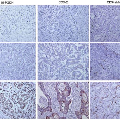 Immunohistochemical Staining Magnification X200 Of 15 Pgdh Cox 2