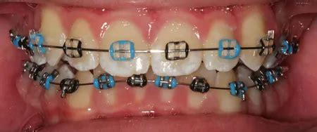 Braces Colours - Show off your personality with colour!