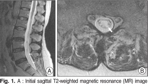 Figure 1 From Spontaneous Spinal Subarachnoid Hemorrhage With