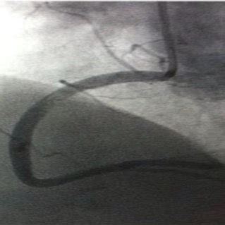 Angiogram after stent implantation. | Download Scientific Diagram