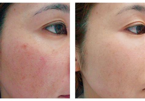 Laser Skin Rejuvenation Laser Of Arlington