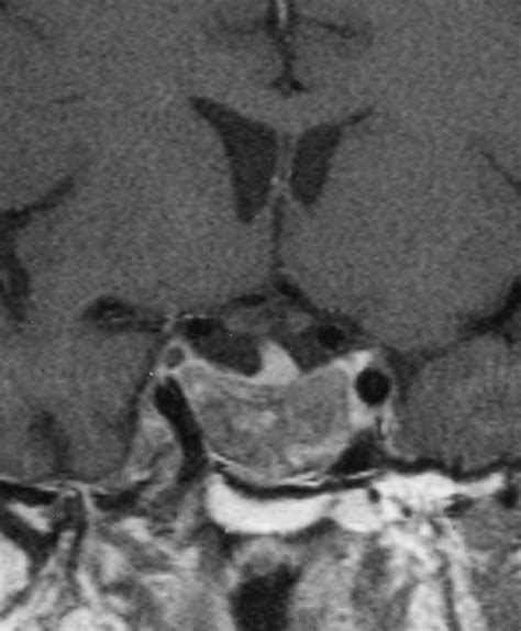 MR Imaging Of Pituitary Adenomas After Gamma Knife Stereotactic