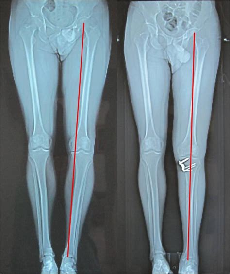 High Tibial Osteotomy - how does it work? | Gorav Datta