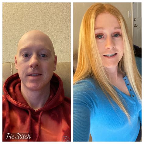 20 Months Hrt 6 Months Post Ffs And 1 Month Post Ba R Transtimelines