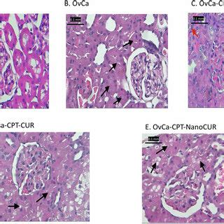 Histopathology Of The Kidney In Ovarian Cancer Rats Treated With