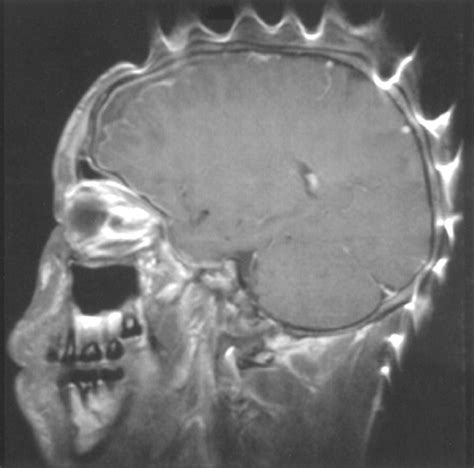 Magnetic Susceptibility Artifacts On Mri A Hairy Situation Ajr