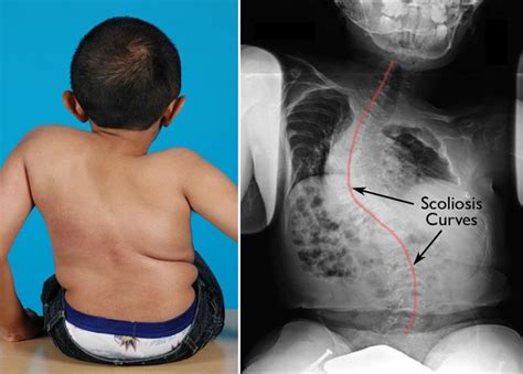 Osteogenesis Imperfecta - OrthoInfo - AAOS