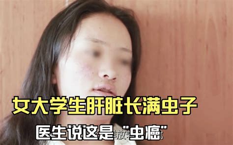 20岁女大学生肝脏长满虫子，已经沦为寄生虫的巨大“巢穴” 哔哩哔哩