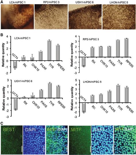 Differentiation Of Retinal Disease Specific Hipscs Into Rpe A Phase