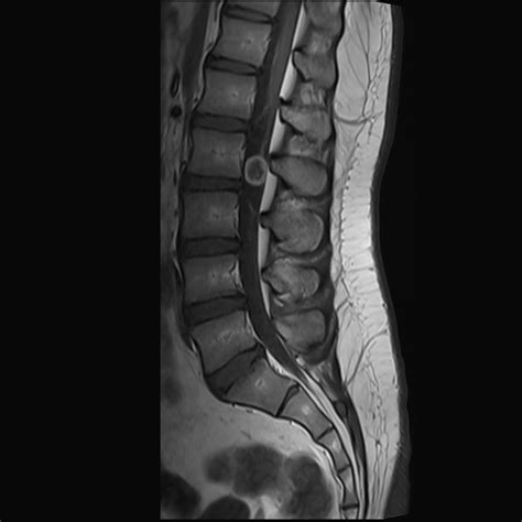 Spinal Schwannoma Image Radiopaedia Org