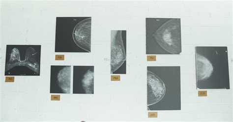 What to Know About Mammography Guidelines | Clinical Perspectives