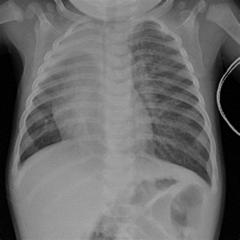 Postoperative view of the laryngeal inlet showing a | Download ...