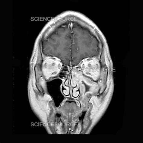 Maxillary Sinusitis Mri Stock Image Science Source Images