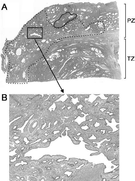 Histology of PIA of the prostate. A: Low-power view of PIA ( dotted ...