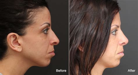 Rhinoplasty Before And After Photos Nicole Schrader Md Facs