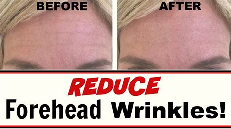 Reduce Forehead Wrinkles Without Botox Youtube