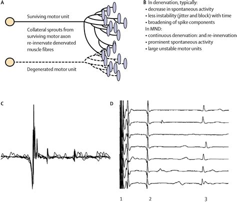 Assessment Of Disease Progression In Motor Neuron Disease The Lancet