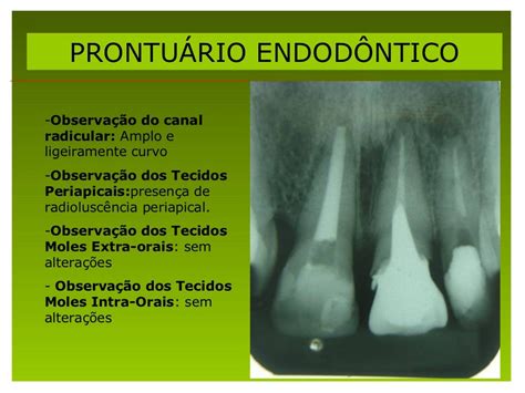 Caso Clínico De Retratamento Endodôntico De Ariane Marinho Endodont