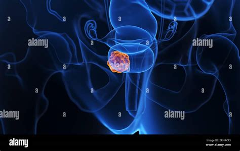 Bladder Tumour Illustration Stock Photo Alamy