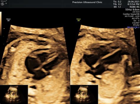 Fetal Echocardiography Cardiac Anomaly Scan